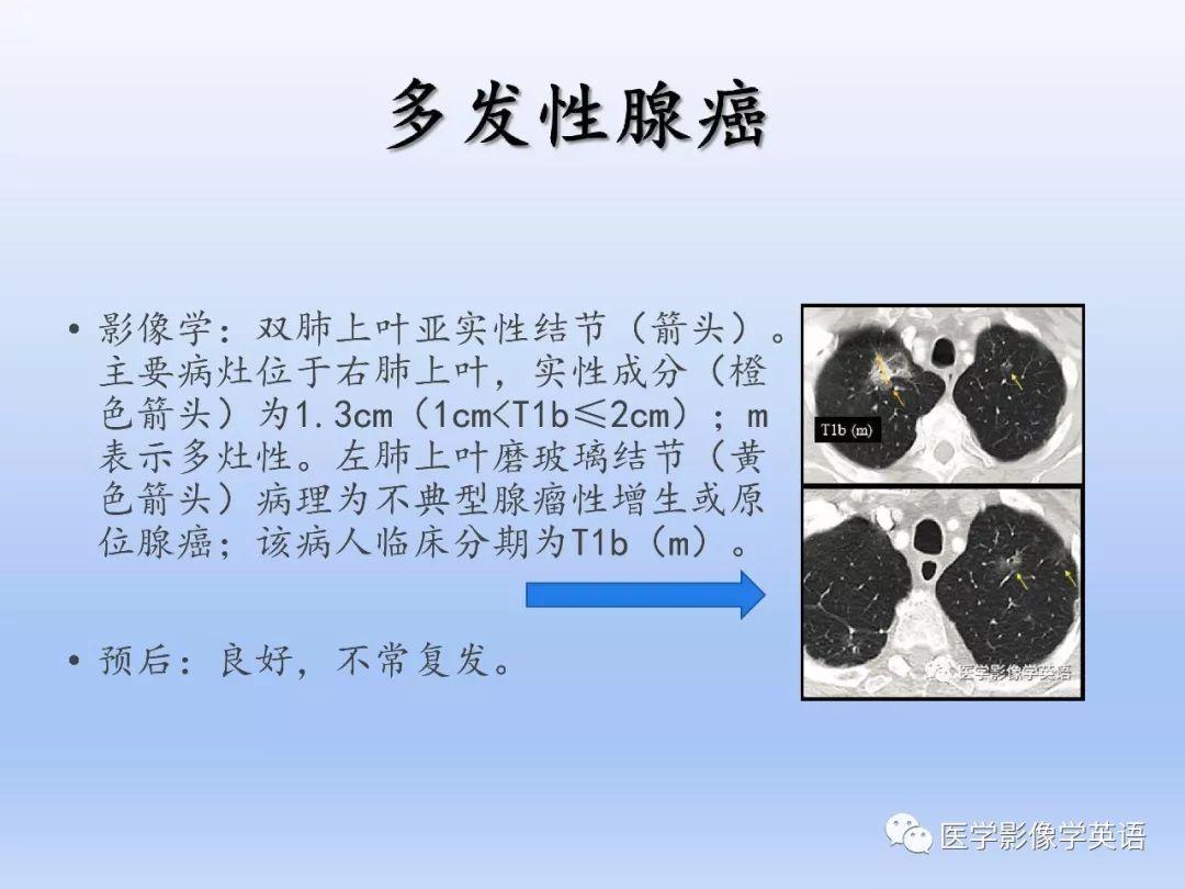 肺癌最新TNM分期详解